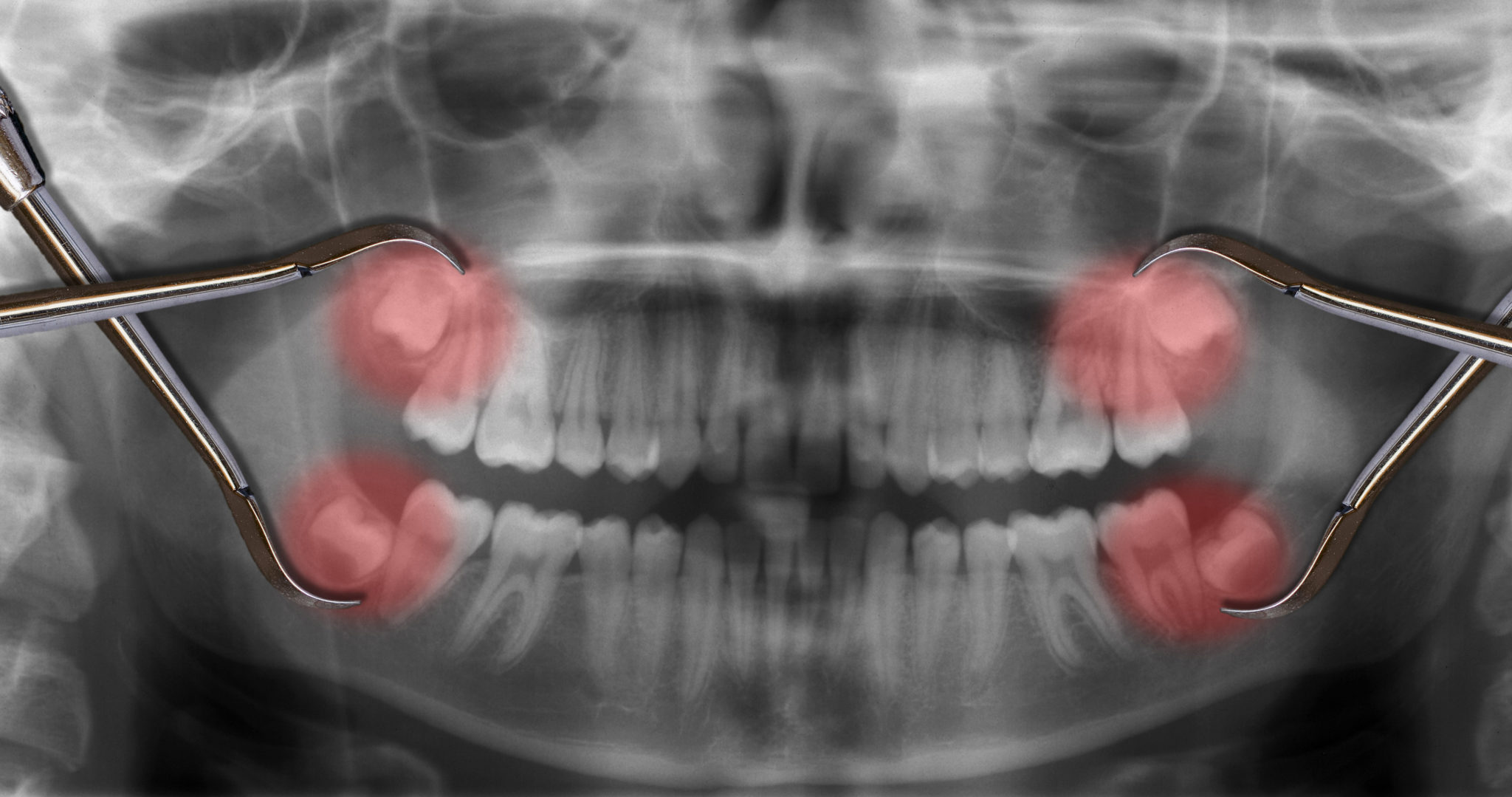 Extraction des dents de sagesse à Djerba - Dr Hassene Rihane